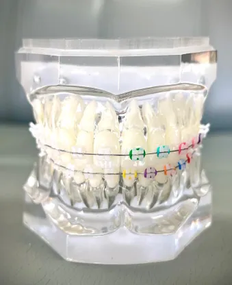 Clear Braces