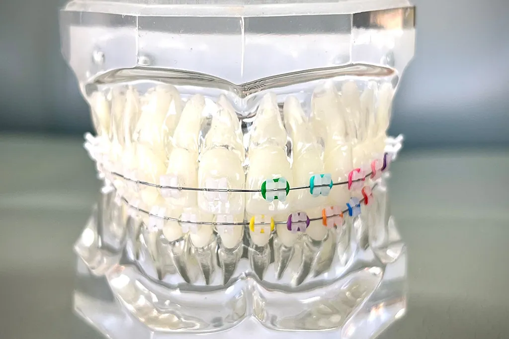 Clear Braces