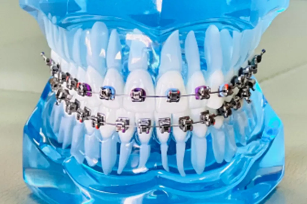 Metal Braces